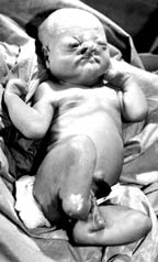 Baby with birth deformaties