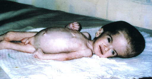 Child with hydrocephalus ... ... next picture ...