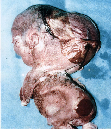 Extreme hydrocephalus; deformity of face, body and ear ... ... next picture ...