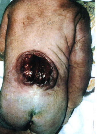 Huge hole in child's back ... ... next picture ...