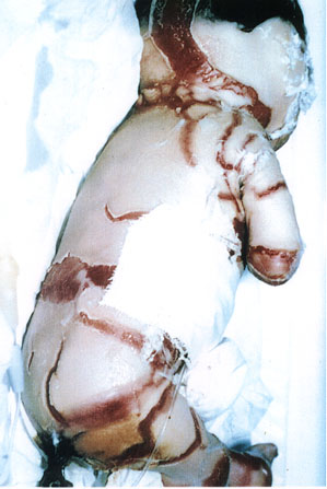  Child with unknown white substance covering almost the whole body. ... next picture ... 