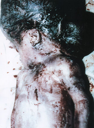 Severe hydrocephalus ... ... next picture ...