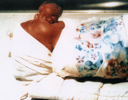 ... deformity of the mouth, possibly a large tumour grown during foetal stage.