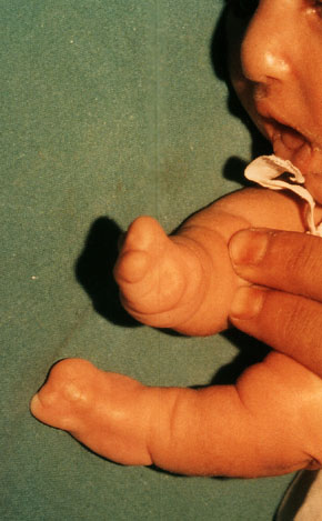 Malformation of hands ...