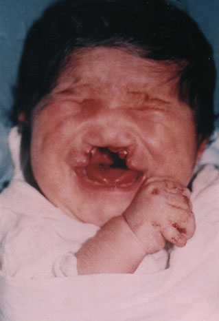 Severe malformation of face.  ... 