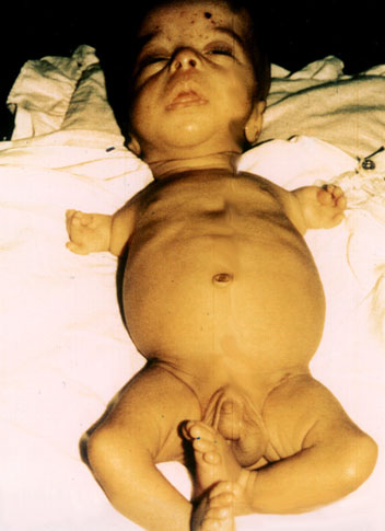 Severe deformity of arms.
