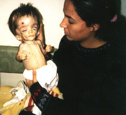 Iraqi child with extreme hydrocephalus, and defects of cerebral nerves.