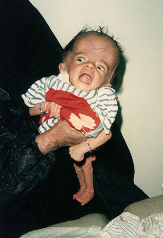 Iraqi child with extreme hydrocephalus